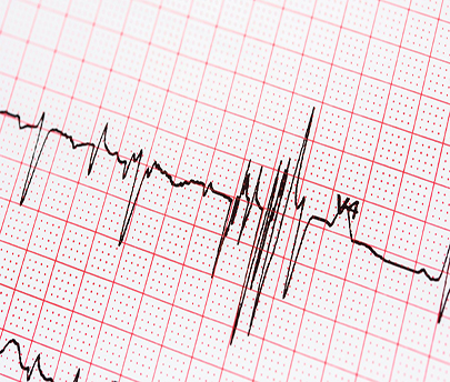 Can Irregular Heartbeats Signal Grievous Health Concerns?