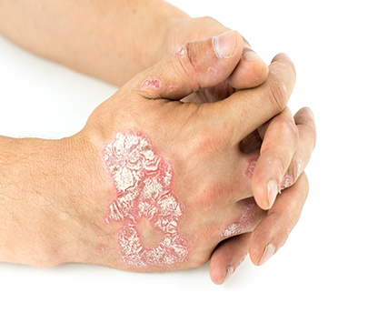 Experts Emphasise Early Psoriasis Treatment